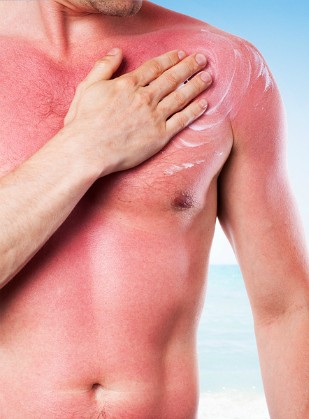 Ouch! I’m Well-Done! Tips For Treating Sunburns
