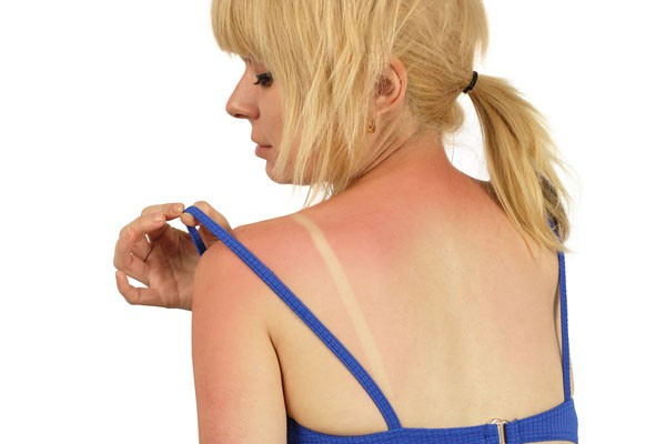 skincare sunburn