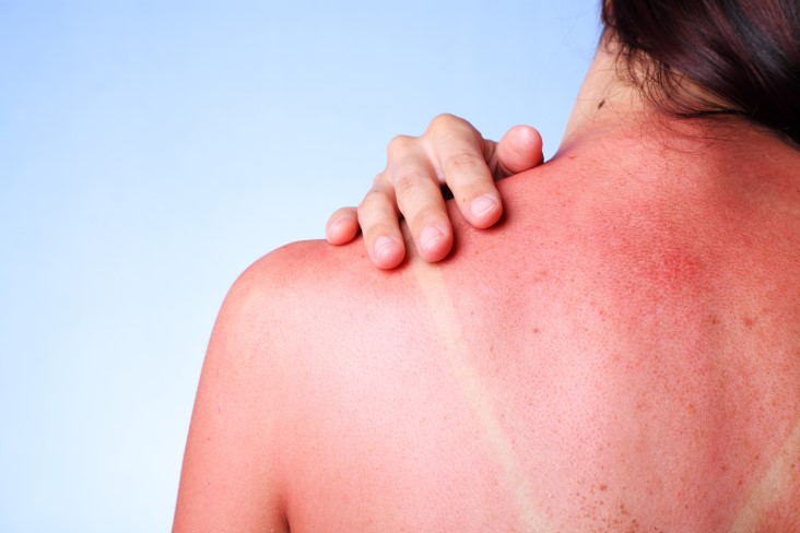 how to deal with sunburns