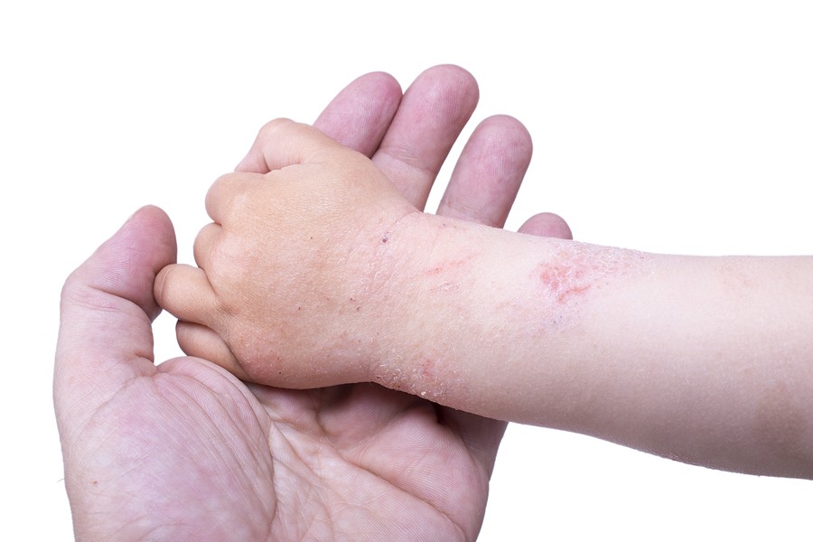 Eczema