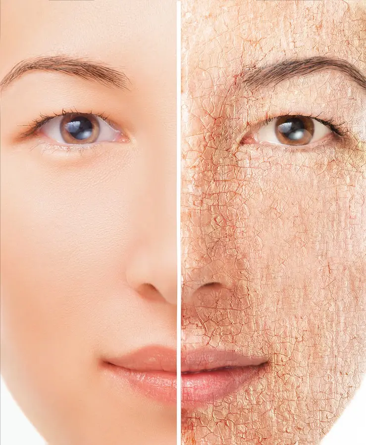 dry skin